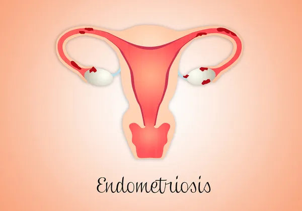 Endometriosis and Its Impact on Fertility and Pregnancy